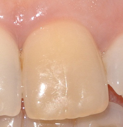 sbaincamento endodontico quadrato
