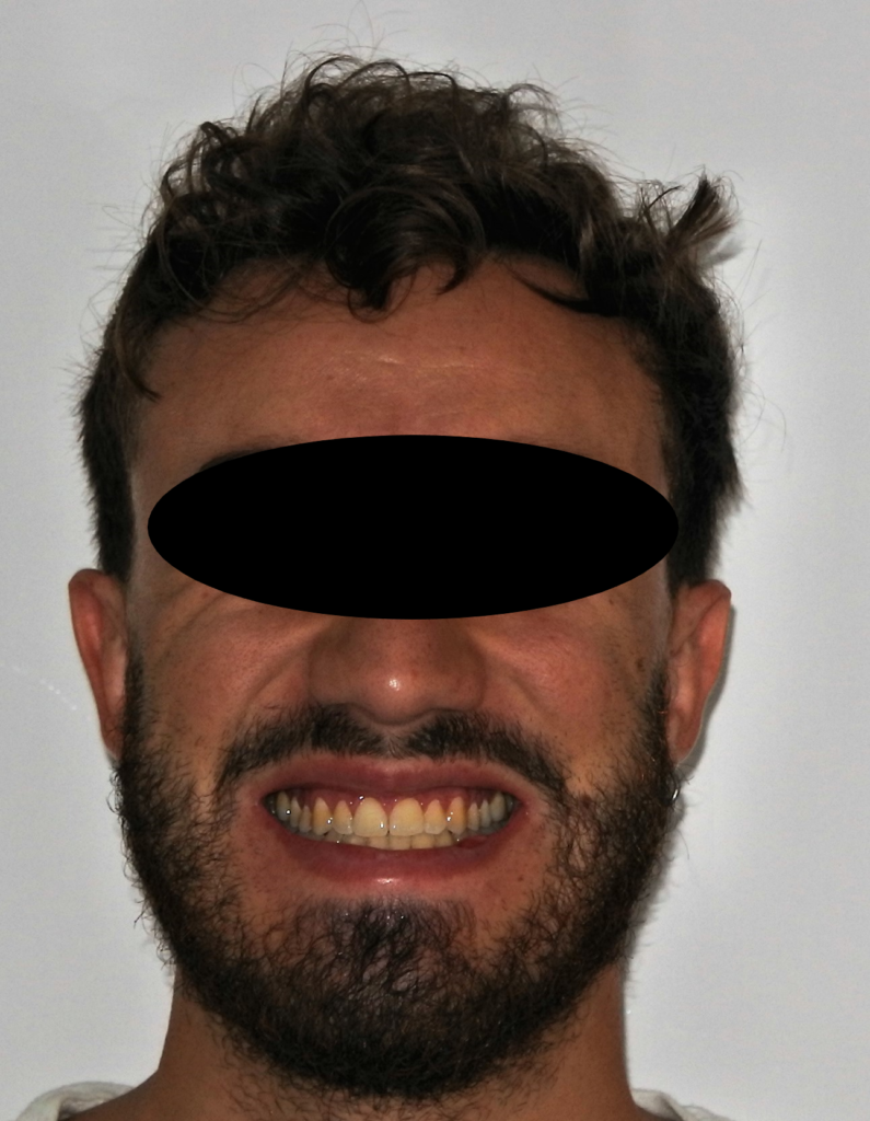 FOTO SORRISO DOPO ORTODONZIA